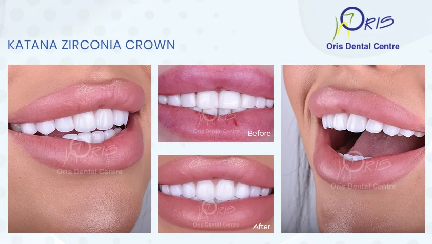 Oris Dental Centre, - Mirdif, Dental Implants, Dental Veneers & Hollywood Smile Specialist photo 4