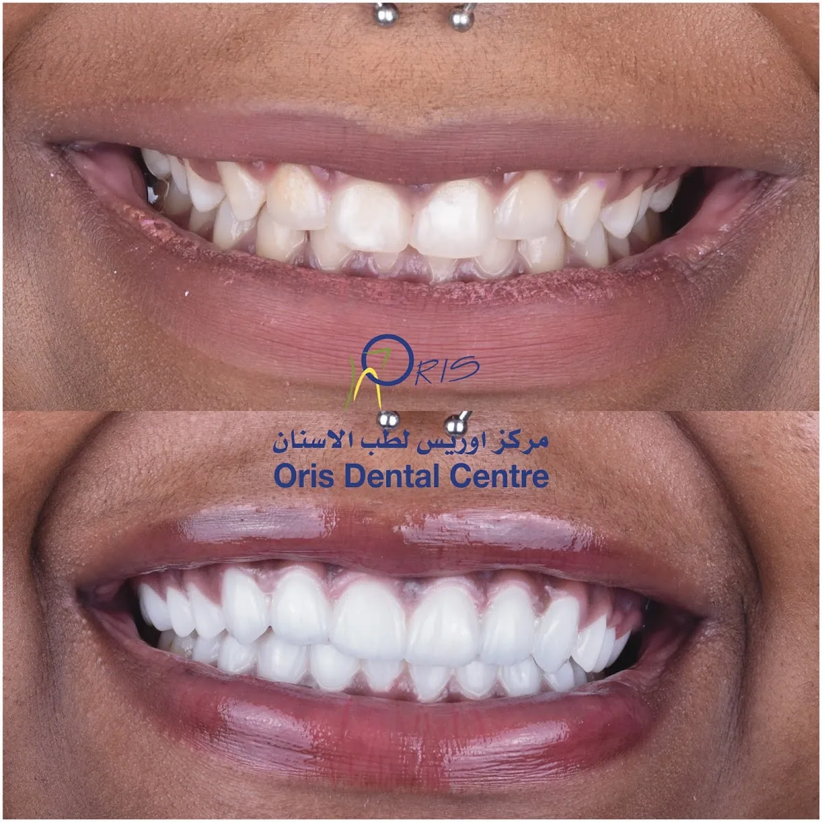 Oris Dental Centre - Jumeirah, Dental Implants, Dental Veneers & Hollywood Smile Specialist photo 3