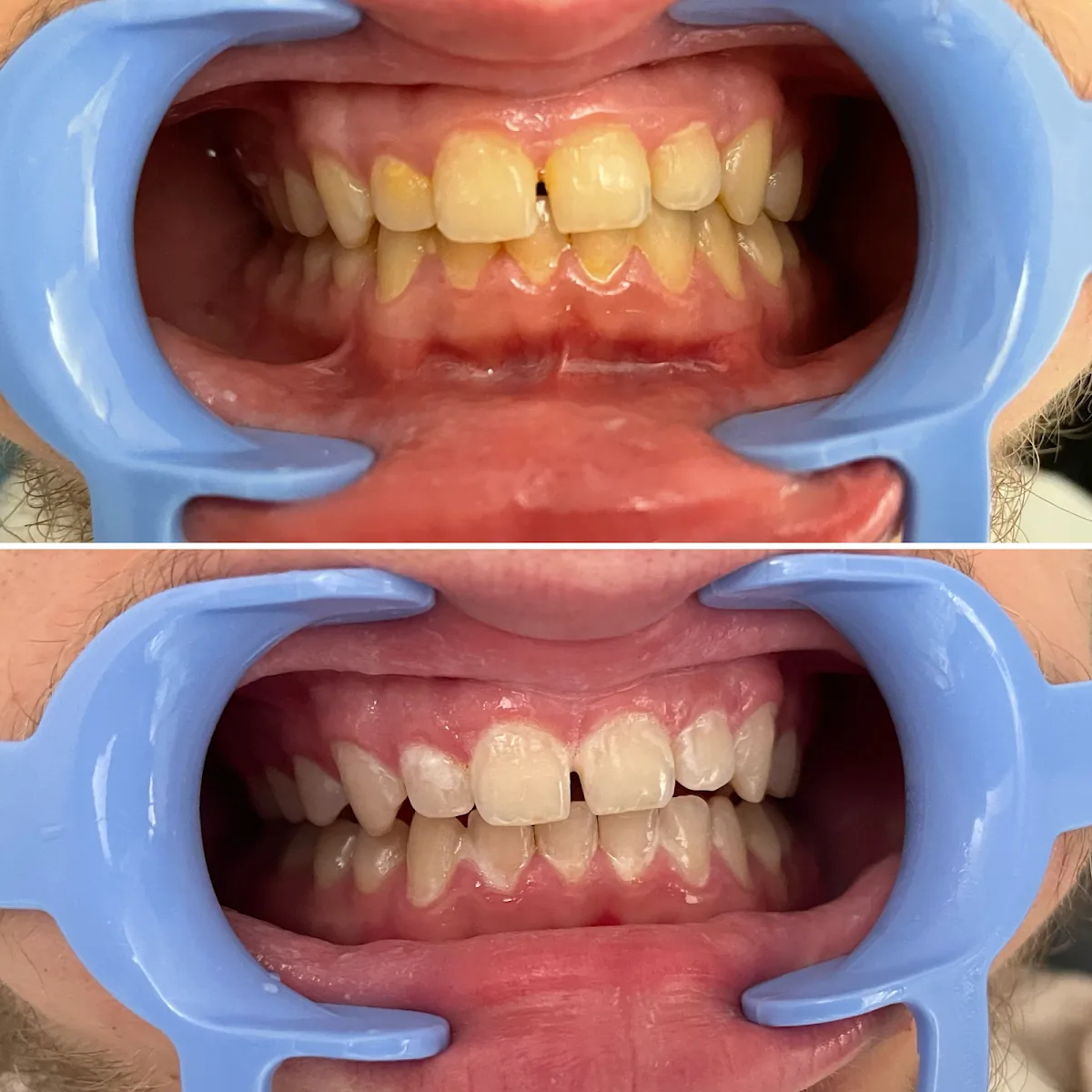 Glow Teeth Whitening photo 2