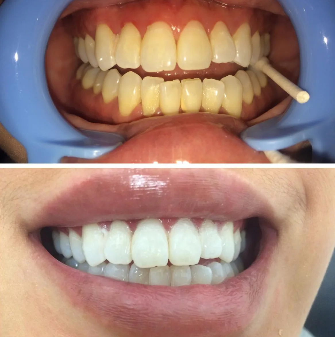 Glow Teeth Whitening photo 3