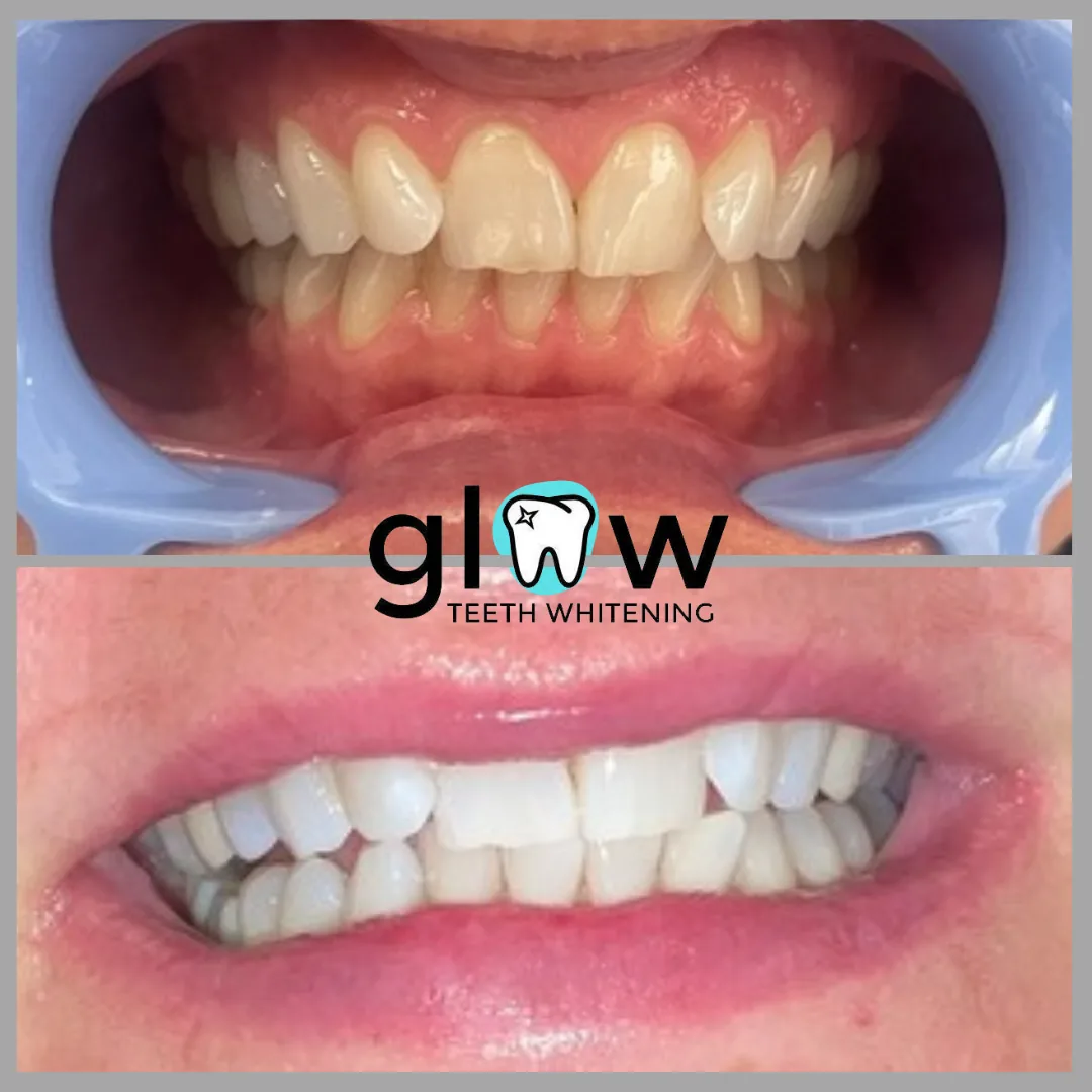 Glow Teeth Whitening photo 1