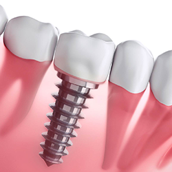 Brij Dental Clinic (Multispeciality Dental Clinic, Laser & Implant Center)