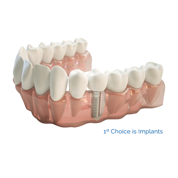 Facets – Cosmetic Dental Clinic