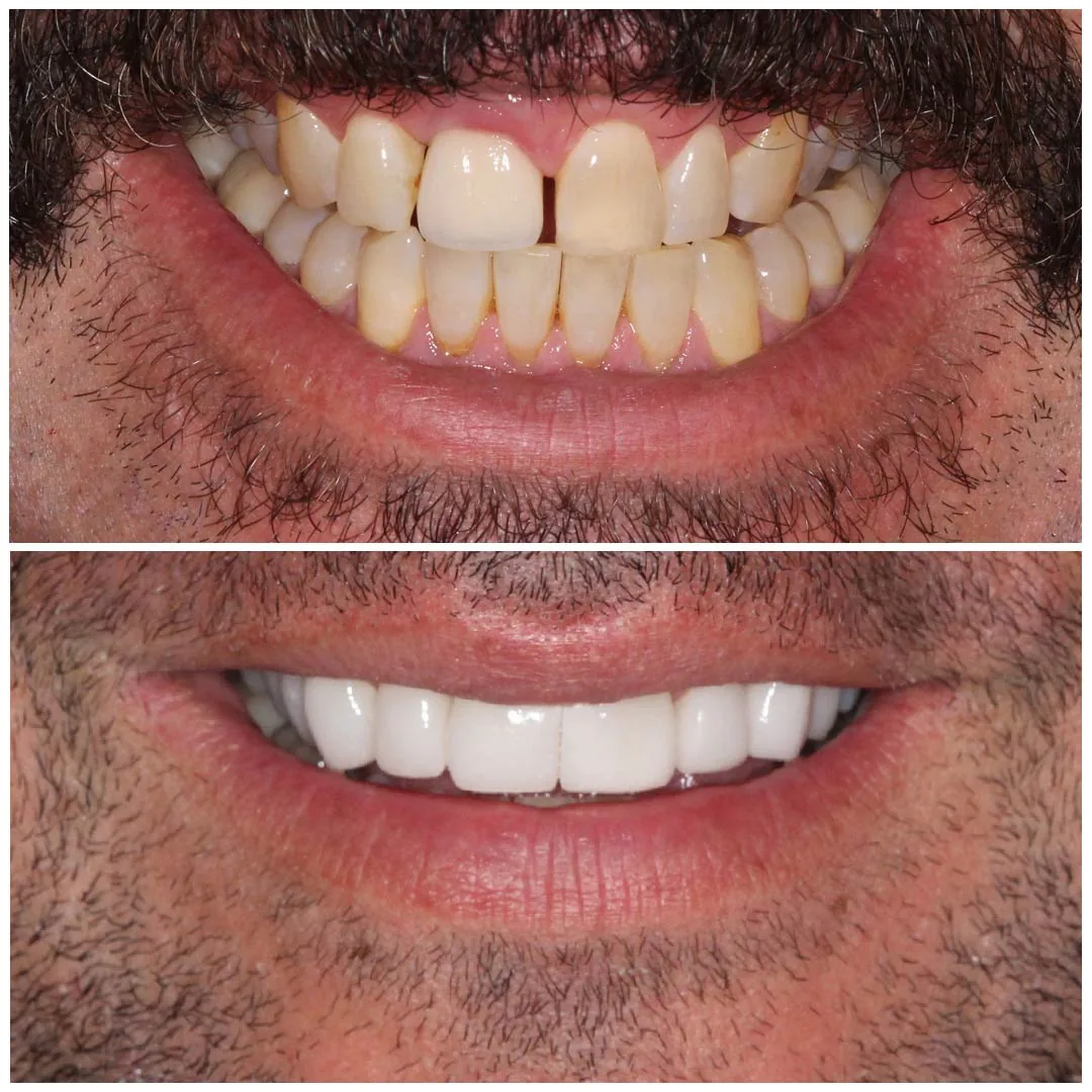 Veneers