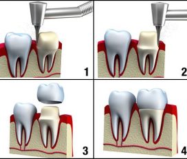 Dentcare 1