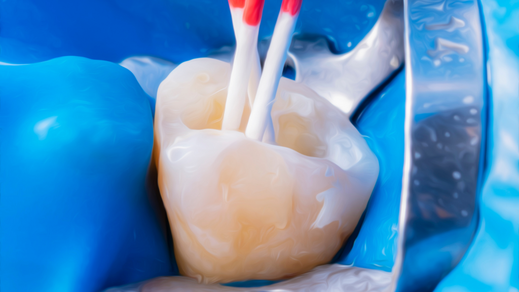 Root Canal Treatment